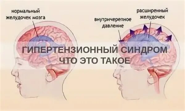Внутричерепное давление симптомы у детей