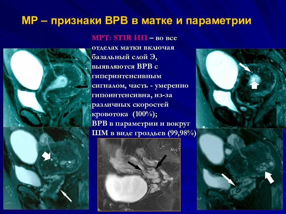 Варикозное расширение вен матки мрт. Варикозно расширенные вены малого таза мрт. Расширение вен матки мрт.