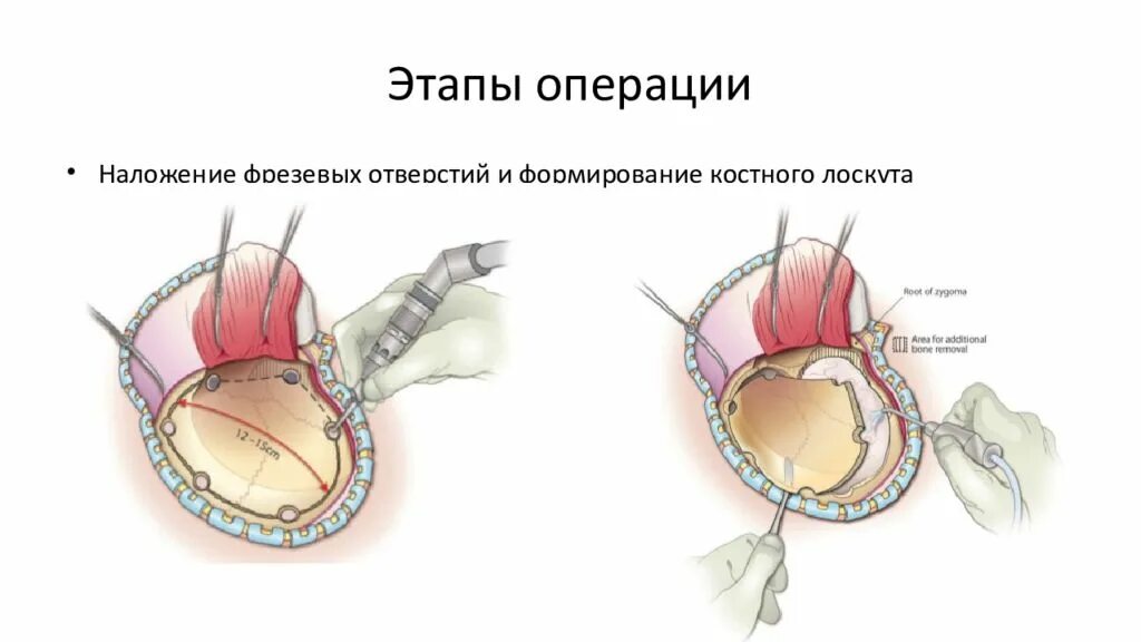 Этапы после операции. Декомпрессивная краниэктомия. Операция этапы операции. Фрезевое отверстие операция. Орхэктомия этапы операции.