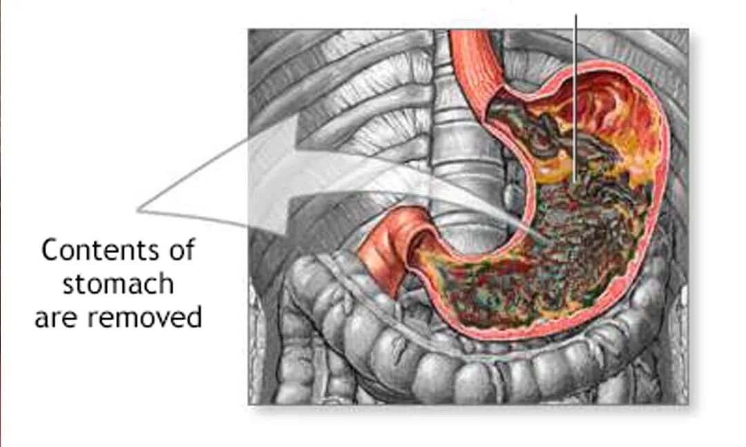 Как быстро очистить желудок. Желудок человека в разрезе.