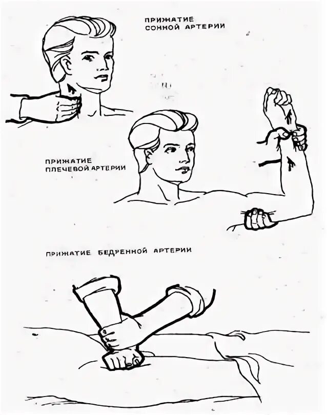 Остановить кровотечение на сонной артерии ответ тест. Кровотечение сонной артерии. Наложение жгута при кровотечении из сонной артерии. Остановка кровотечения из сонной артерии. Остановка кровотечения из сонной артерии алгоритм действий.