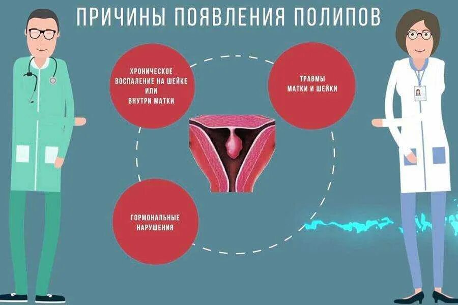 При полипе можно забеременеть. Полип цервикального канала. Удаление полипа цервикального канала. Причины появления полипа в матке. Причины появления полипов.