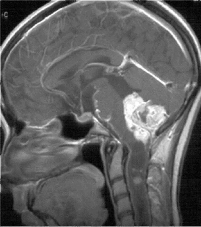 Менингиома мозжечка мрт. Гемангиобластома мозжечка мрт. Мозжечковая опухоль