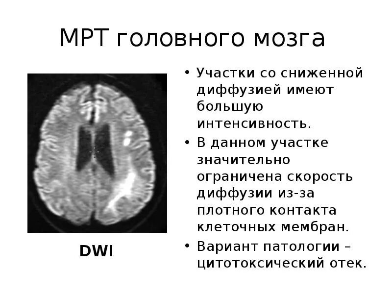 Отек мозга g 93.6 причина. Вазогенный отек головного мозга кт. Цитотоксический отек головного мозга кт. Вазогенный отек головного мозга на мрт.