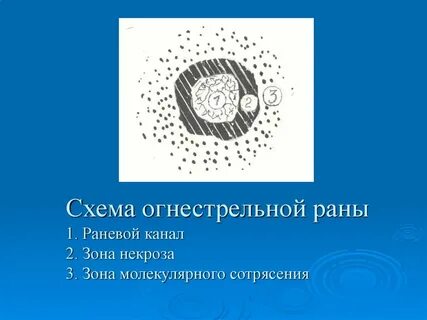 Зоны ранения