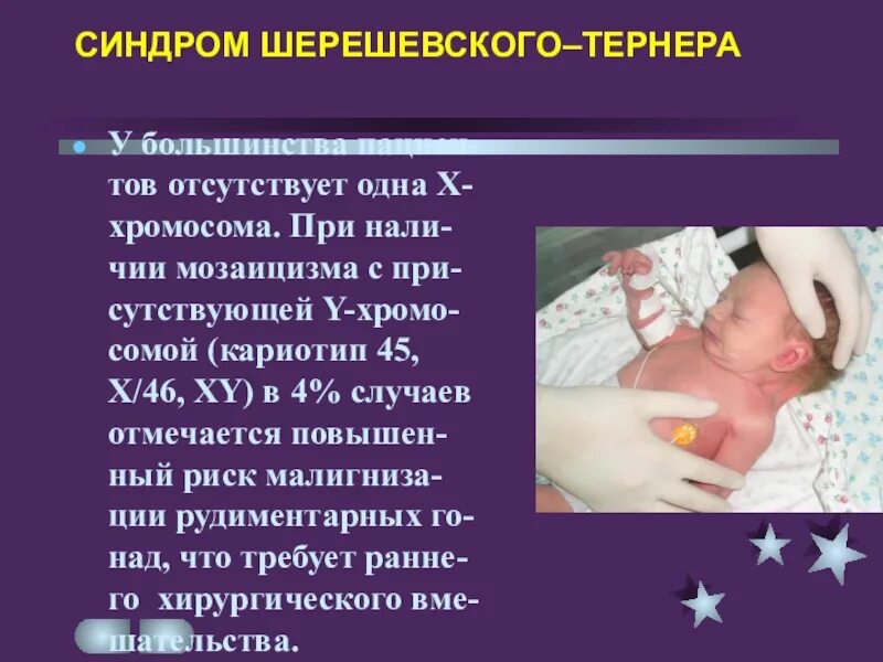 Фенотип при синдроме шерешевского-тернера. Лечение синдрома шерешевского. Лечение синдрома шерешевского. Cbylhjv ithtdthcrjuj tnhythf. Синдром шерешевского тернера 45,0х.