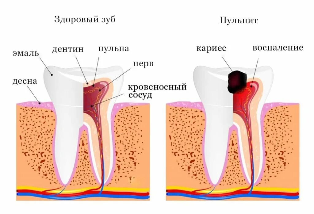 Пульпит 2 канального зуба. Пульпит корневого канала. Травматический пульпит. Кариес пульпит периодонтит. Нерв гниет.