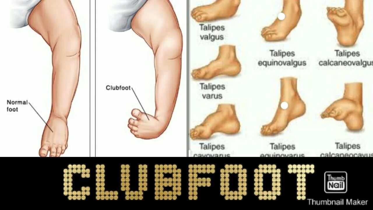 Классификация косолапости по понсети. Эмблема фут клуб жалгерис. Club foot перевод. Club foot перевод. Club foot перевод.