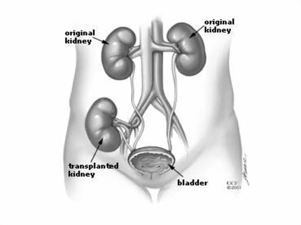 Схема операций трансплантации почки. Трансплантация почки этапы. Анатомия почки трансплантация. Пересадка почки в россии