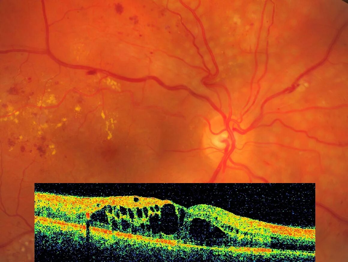 Макулопатия макулярный отек. Ламеллярный макулярный разрыв. Ламинарный макулярный разрыв. Ламеллярный разрыв сетчатки глаза. Макулопатия глаза