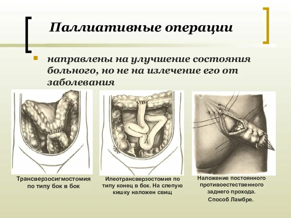Операция прогноз. Паллиативная операция. паллиативные хирургические вмешательства. паллиативная хирургическая операция. паллиативная онкологическая операция.