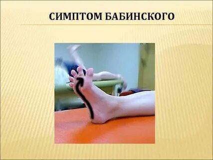 Симптом бабинского