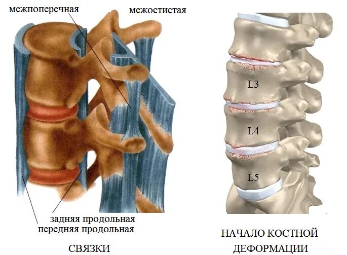 L1-l4 деформирующий спондилез. Спондилёз пояснично-крестцового отдела l1 l2. Деформирующий спондилез l2 l5. Спондилез передней продольной связки.