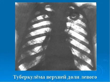 Очаг в верхней доле левого легкого