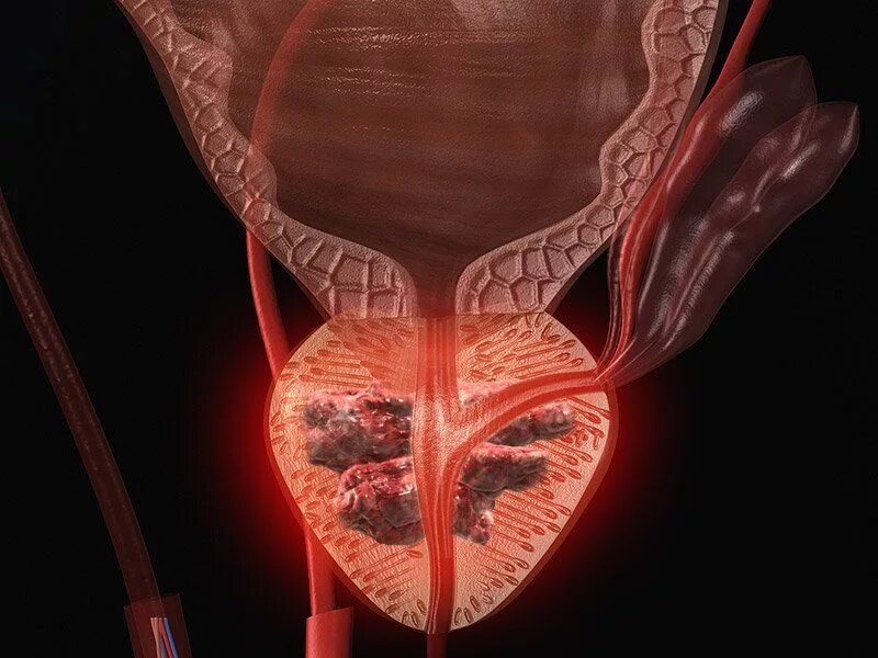 Медицина простатит. Простатит предстательной железы. Онкология предстательной железы. Воспаленная предстательная железа.
