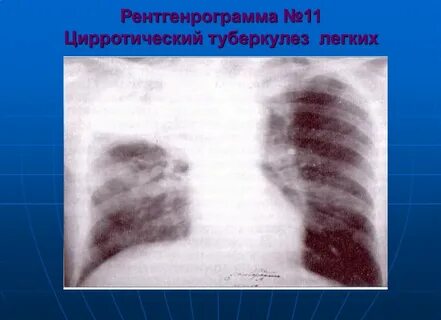 Кавернозно цирротический туберкулез