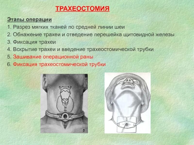 Операция состоит из этапов