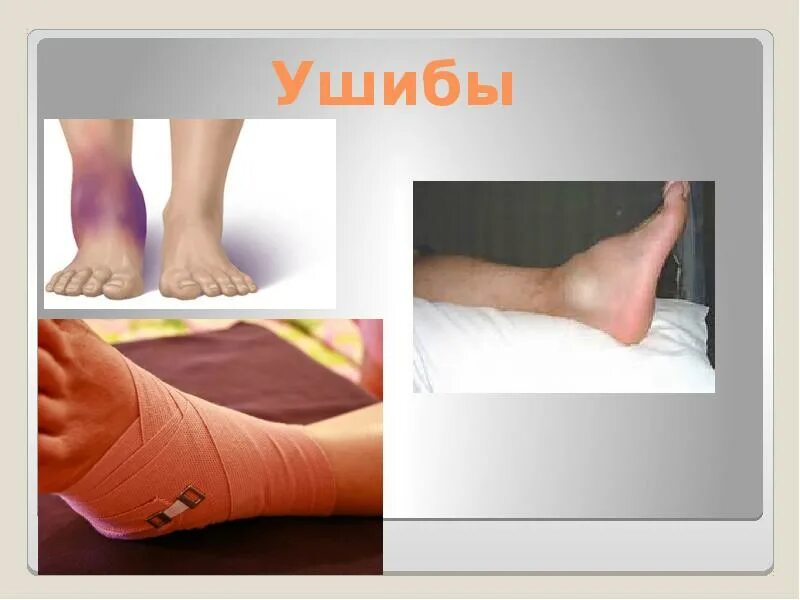 Как отличить перелом от ушиба. Ушибы и переломы презентация.