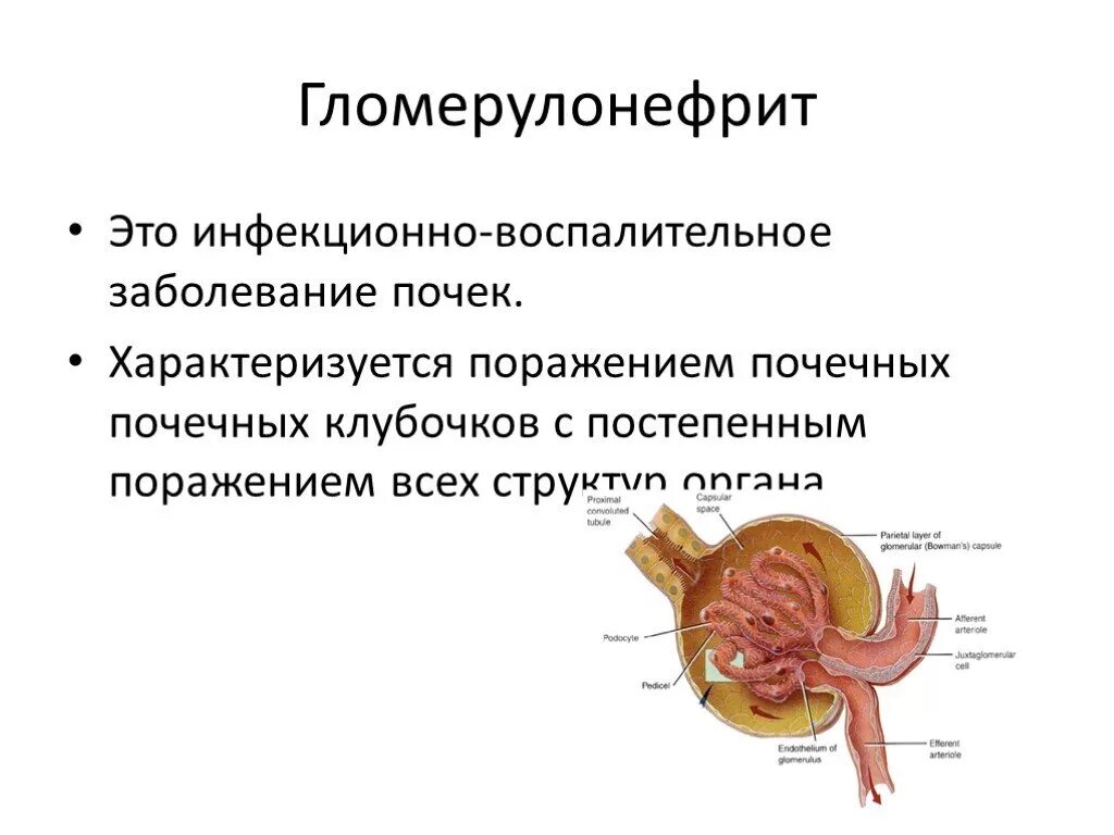 Почка пораженная гломерулонефритом. Гломерулонефрит почечный клубочек. Поражение клубочков гломерулонефрит. Клубочки почек гломерулонефрит. Поражение клубочков почек