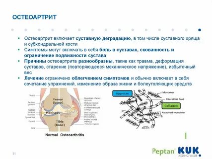 Остеоартрит лечение