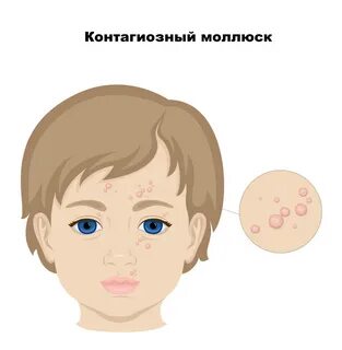 Как удалить моллюск