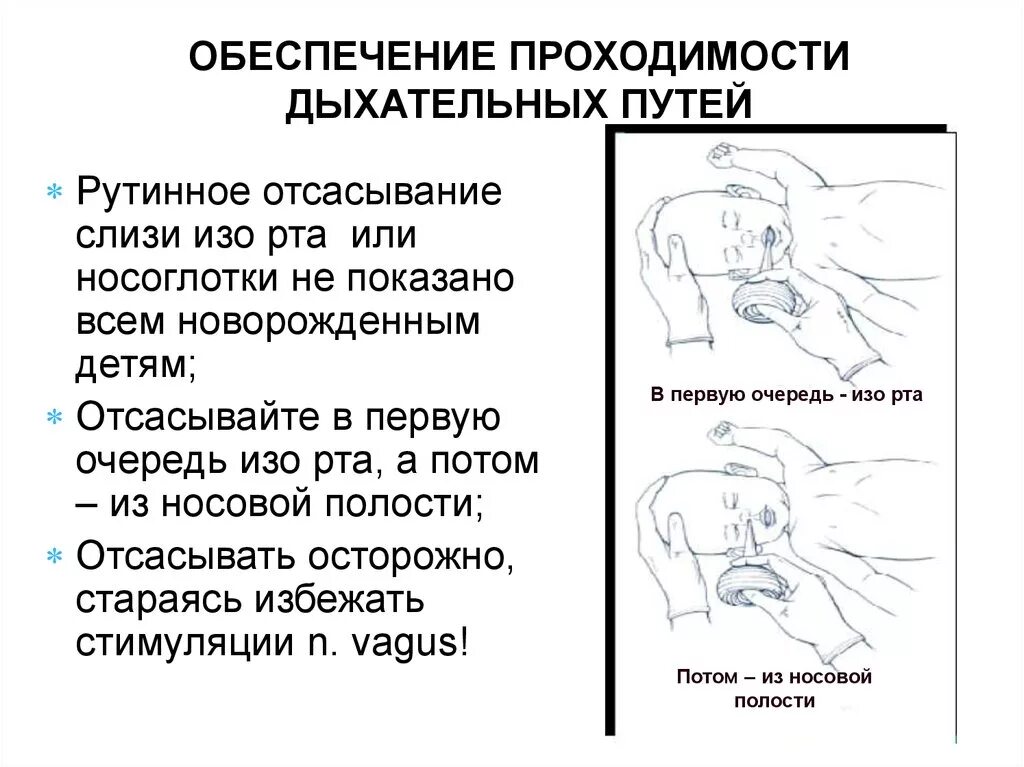 Технику отсасывания слизи из дыхательных путей новорожденных. Отсасывание слизи из верхних дыхательных путей. Отсасывание слизи из верхних дыхательных путей алгоритм. Отсасывание слизи у новорожденного алгоритм.