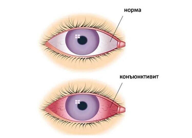 Конъюнктивит лечение быстро и эффективно. Бактериальный конъюнктивит глаз. Коньюктивит коньюктивит коньюктивит. Воспалился глаз конъюнктивит. Конъюнктивит светобоязнь.