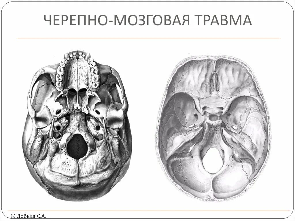 Черепно-мозговая травма. Черепная мозговая травма. Черепно-мозговая черепно-мозговая травма.