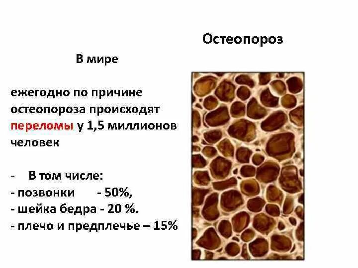 Нарушение плотности костей