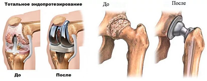 Эндопротезирование коленного и тазобедренного сустава. Тазобедренный эндопротез Stryker. Тотальное эндопротезирование сустава. Одномыщелковое эндопротезирование коленного сустава. Бесплатная замена коленного сустава