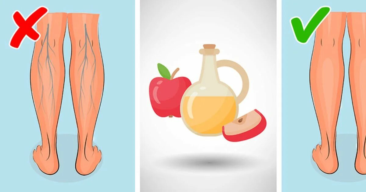 уксус при варикозе вен на ногах