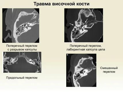 Симптомы продольного перелома височной кости