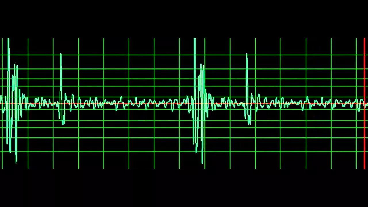 Звуки тона сердца. Линия звука. Звук сердца. Голосовое аудио сердце. Очень громкий звук сердца.