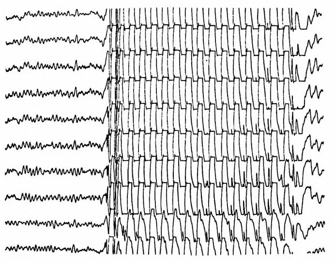 Эпи ээг. Абсансная эпилепсия на ЭЭГ. Эпилептические паттерны на ЭЭГ. Миоклоническая эпилепсия ЭЭГ. ЭЭГ паттерны юношеской миоклонической эпилепсии.
