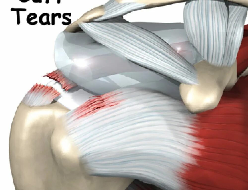 Тендинит сухожилия надостной мышцы плечевого. Сухожилия ротаторной манжеты плечевого сустава. Тендинит мышц вращательной манжеты. Тендинит ротаторной манжеты плечевого сустава. Разрыв плечевого сустава симптомы