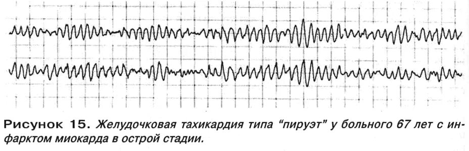 пируэтная желудочковая тахикардия на экг. пируэтная желудочковая тахикардия на экг. желудочковая тахикардия gj nbge gbhet'n. полиморфная желудочковая тахикардия типа пируэт на экг.