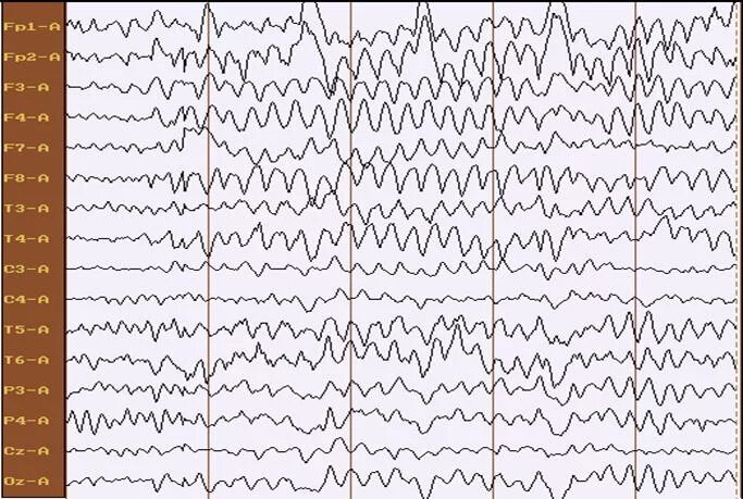 Эпилептиформные паттерны на ЭЭГ. Региональная эпилептиформная активность ЭЭГ. Эпилептический очаг на ЭЭГ. ЭЭГ волны при эпилепсии. Пароксизмальная активность мозга