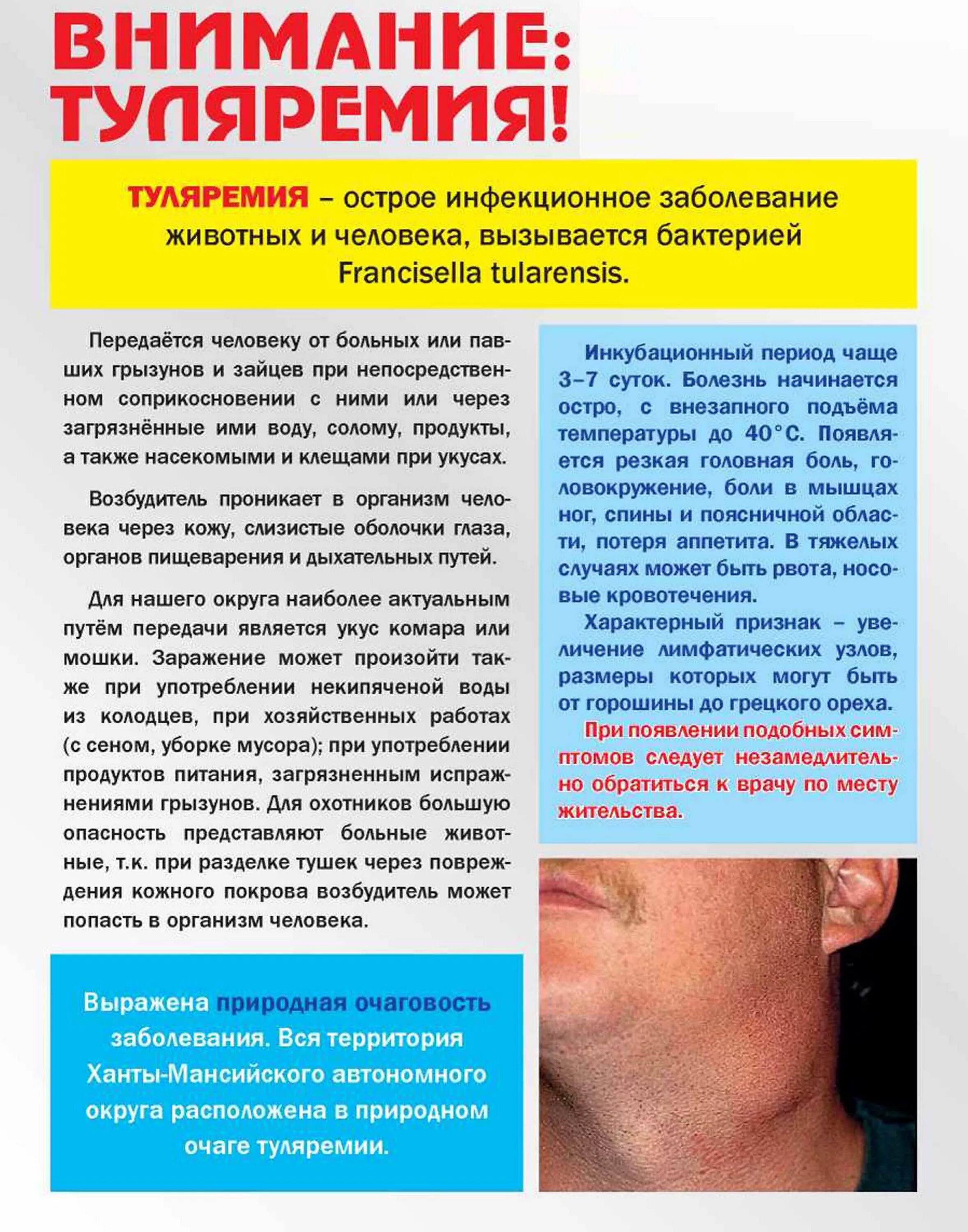 Вакцинация против туляремии. Туляремия профилактика заболевания. Туляремия прививка от чего.