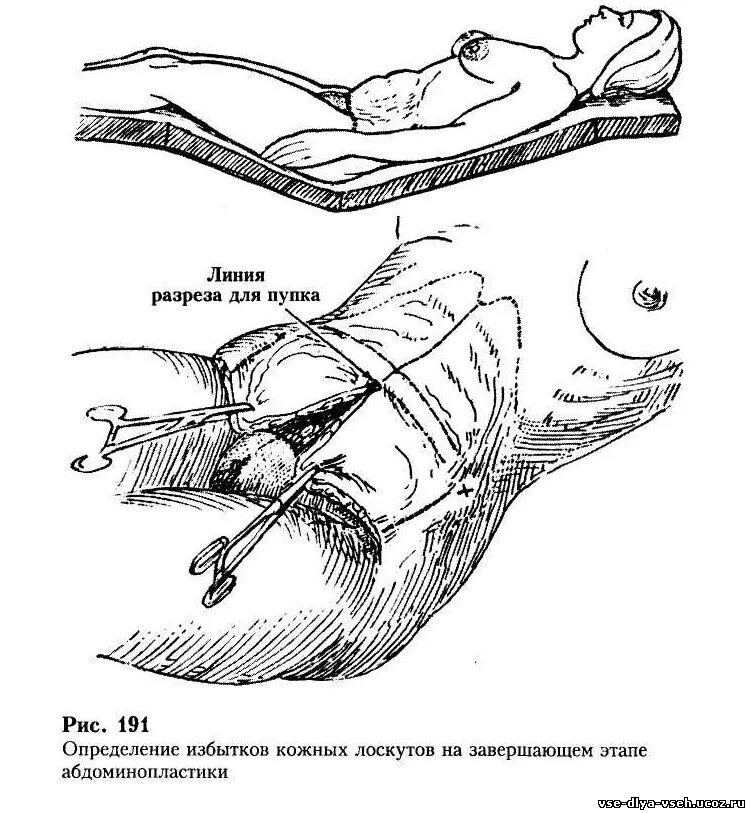 Абдоминопластика живота методы. Операция разрез живота. Мышцы живота и паховый канал анатомия. Грыжесечение метод сапежко. Апоневрозы мышц передней брюшной стенки.
