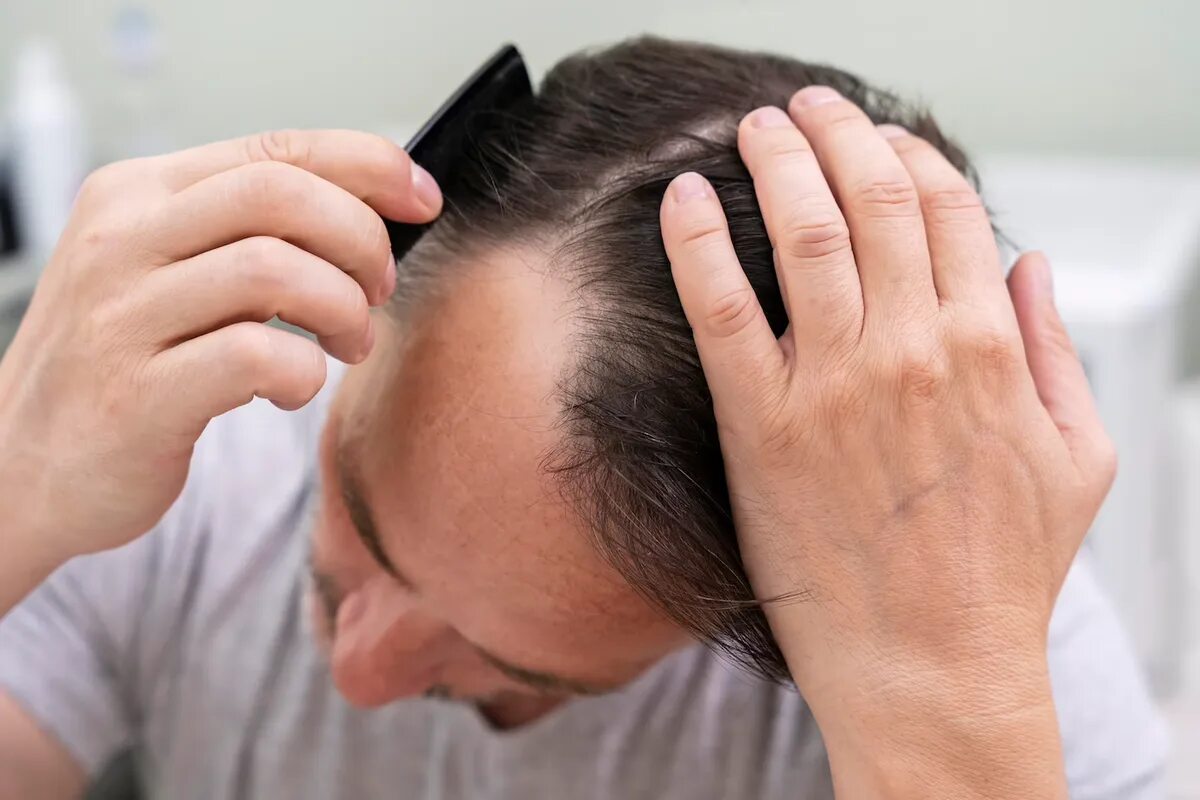 Очаговая алопеция (alopecia Areata). Виды облысения у мужчин фото. Лысина у мужчин. Массаж головы при облысении у мужчин. Симптомы алопеции