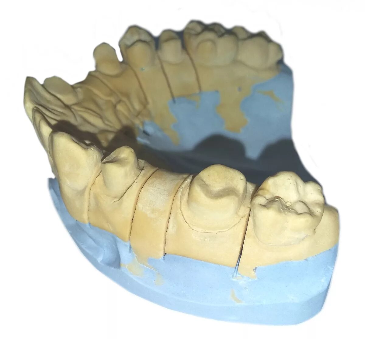 Изготовление разборной модели. Разборная модель. Разборная гипсовая модель. Гипсовая модель зубов. Разборная модель в стоматологии.