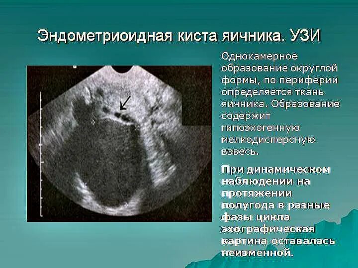 Эхо признаки кисты. Эндометриоидные кисты яичника. эндометриоидная киста яичника на узи. эндометриоидные кисты яичников узи.