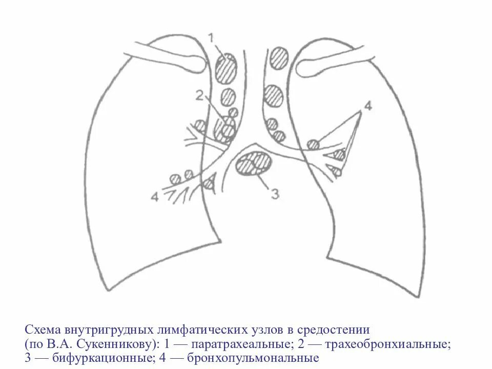 Узлы в легких что это. Туберкулез внутригрудных лимфоузлов кт. Лимфоузлы средостения схема. Бронхопульмональные лимфоузлы на кт. Лимфатические узлы средостения.