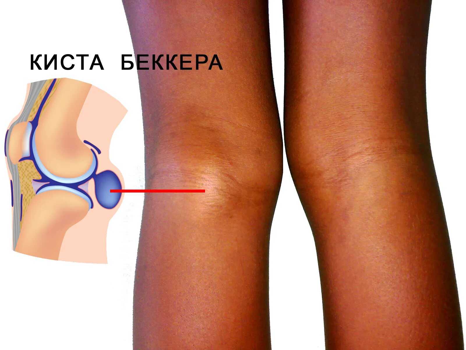 Колена ли. Киста Бейкера гонартроз. Синовиальная киста Бейкера. Подколенная киста Бехтерева.