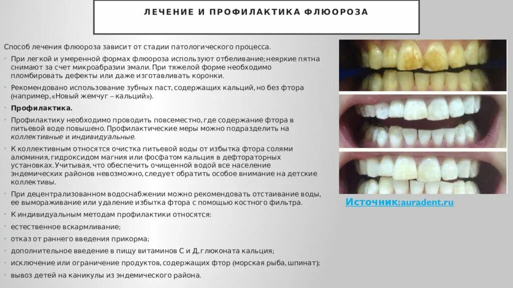Переизбыток фтора на зубах как выглядит Повышенное содержание фтора в воде: найдено 58 изображений