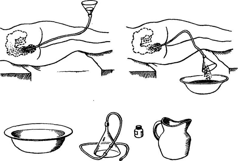 Клизма микролакс как пользоваться. Микролакс р-р д/рект введ микроклизмы 5 мл х4. Постановка лечебной клизмы алгоритм. Очистительная клизма кружка эсмарха алгоритм. Очистительная клизма оснащение.
