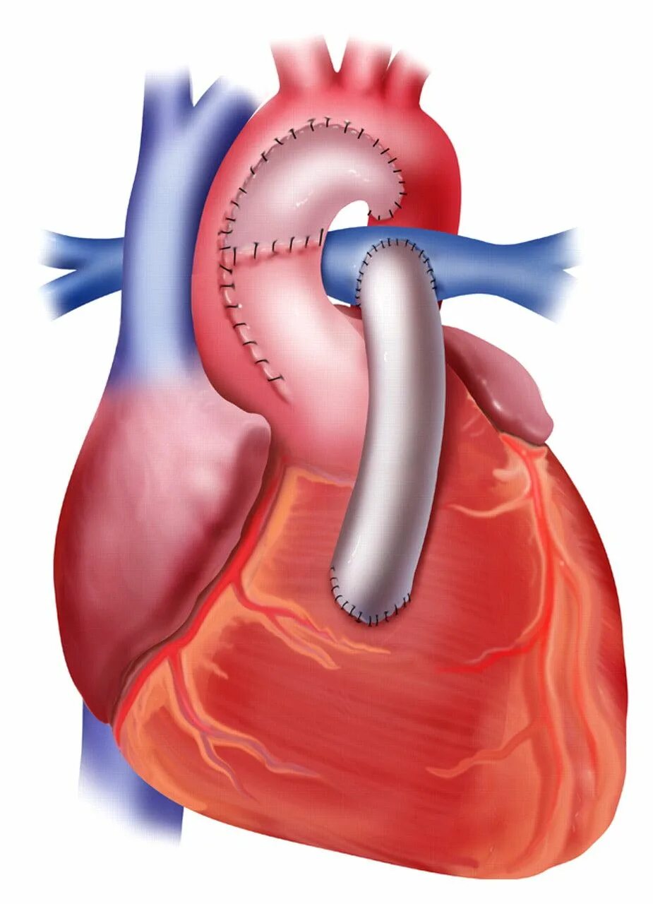 Врожденный порок сердца (ВПС). Врожденный порок сердца операция.