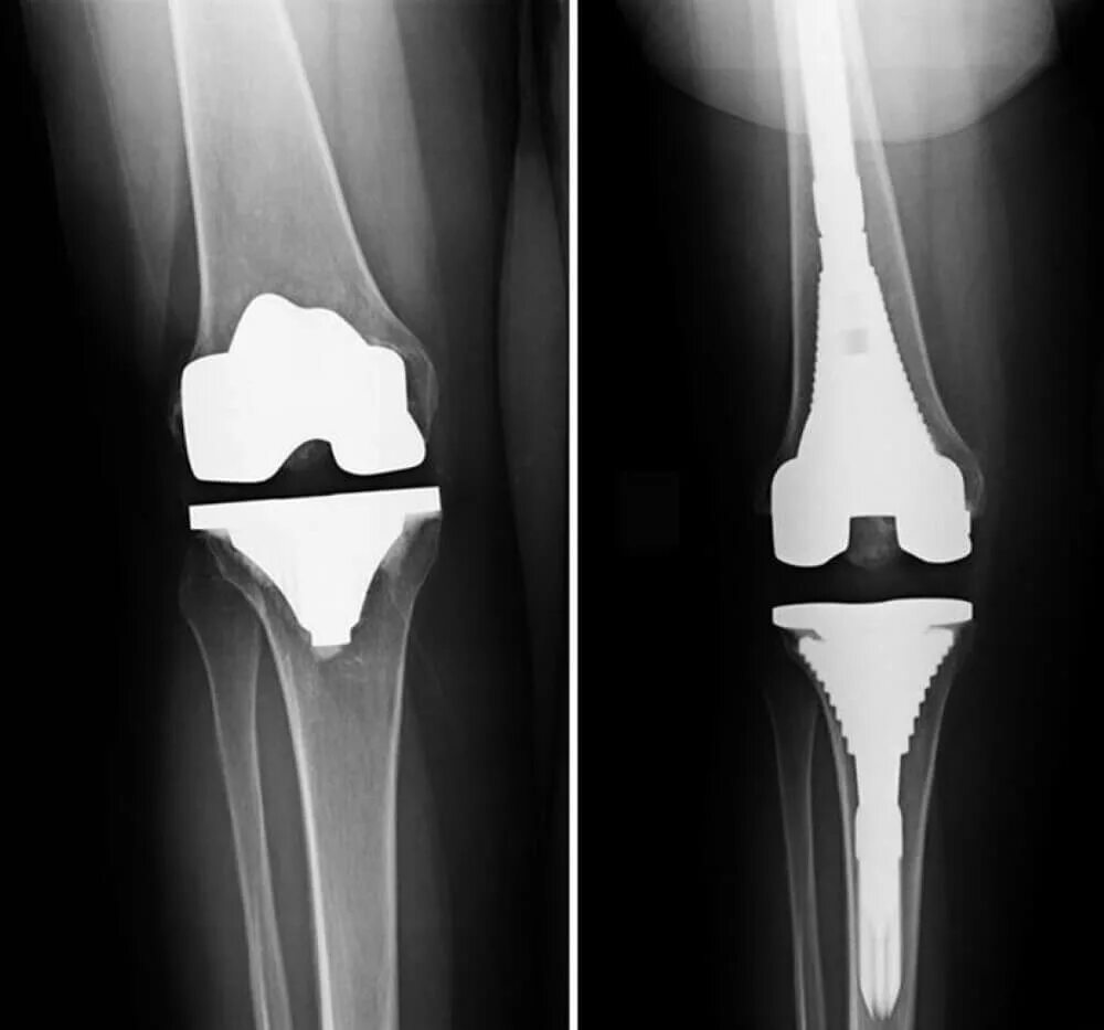 Эндопротезирование коленного сустава операция. Ревизионное эндопротезирование коленного сустава. Эндопротез коленного сустава титановый. Субтотальное эндопротезирование коленного сустава.