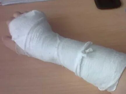 Рука девушки в гипсе