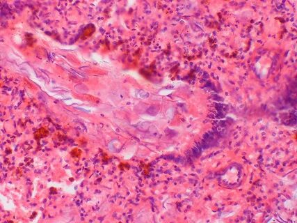 Human disease